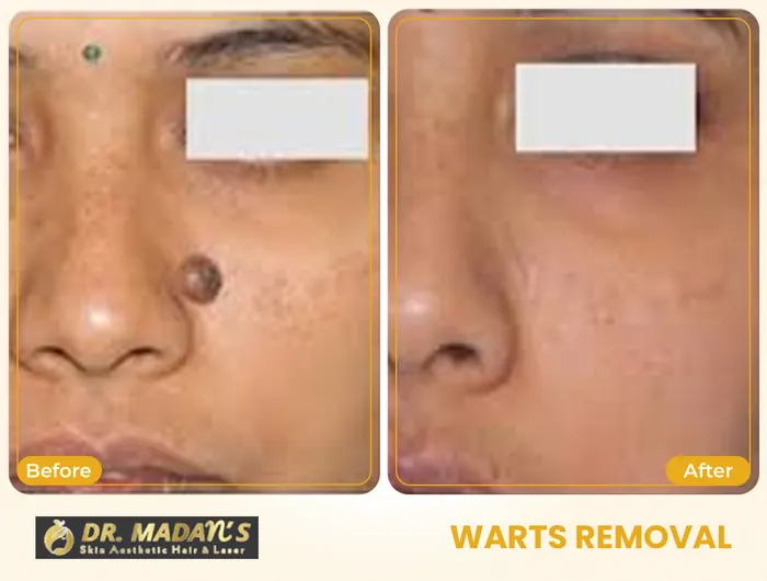 Warts removal before and after result 7 at Dr Madan Aesthetics